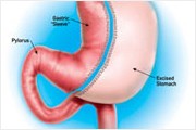 Illustration showing that a portion of the stomach is removed during a Vertical Sleeve Gastrectomy