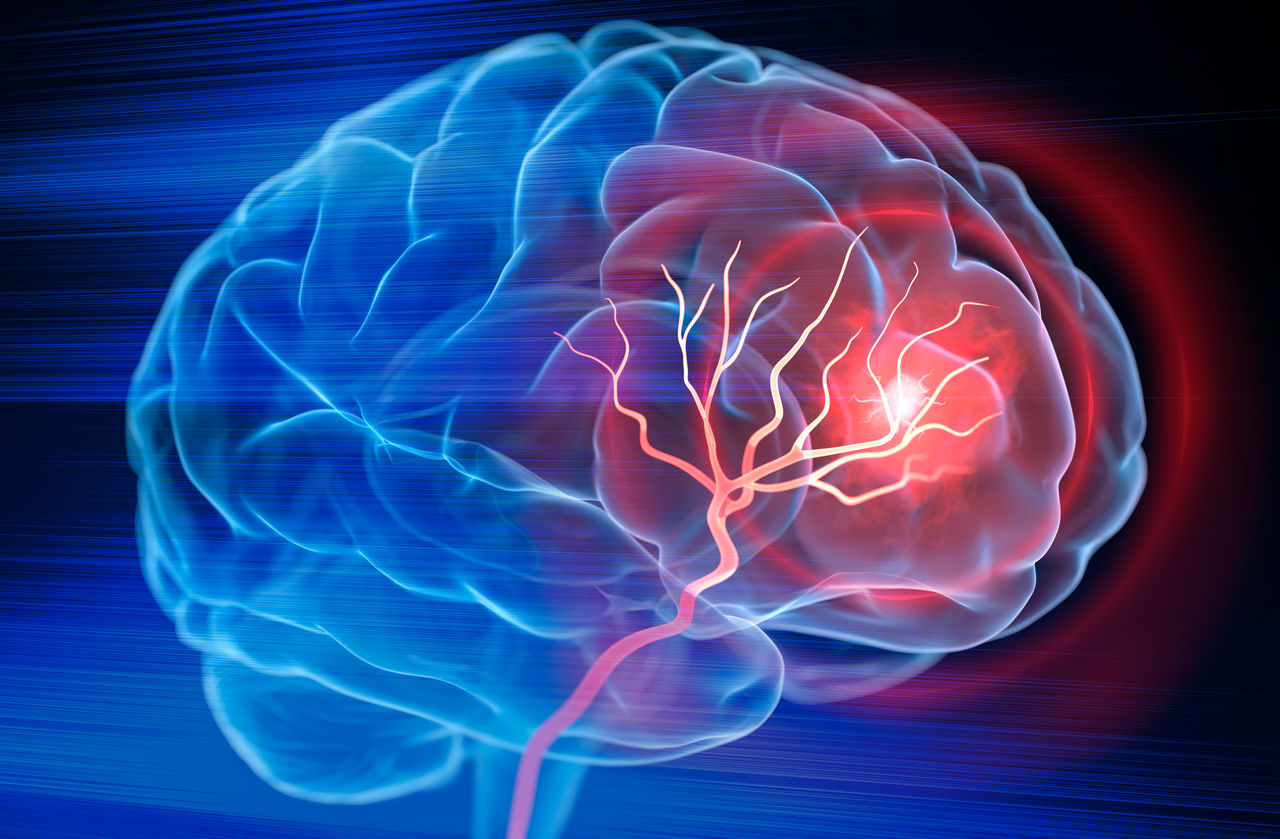 X- Ray illustration of brain stroke - 3d Illustration