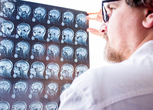 A neurologist evaluates results of MRI for an epilepsy patient.