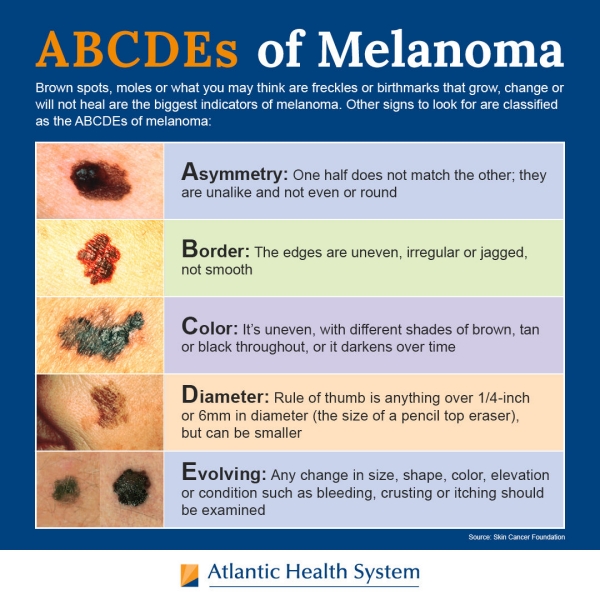 An infographic detailing the ABCDEs of Melanoma.