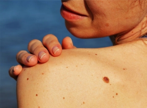 womens shoulder with moles