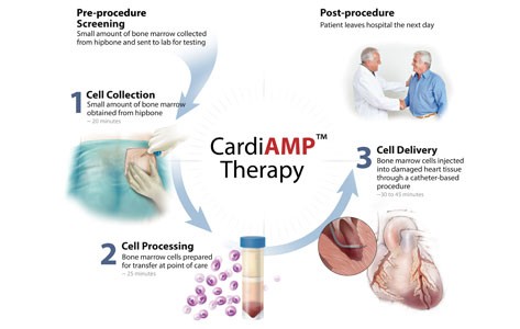 CardiAMP Therapy