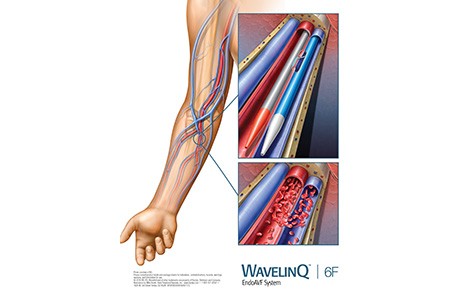 WavelinQ non-surgical dialysis