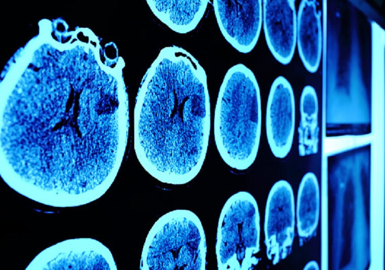 Imagen de tomografía computada craneal en la pared en perspectiva, tonos azules.