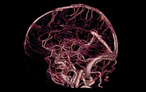 Angiografía cerebral