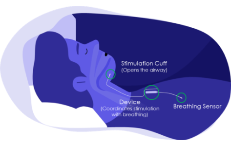 Cómo funciona el dispositivo Inspire para la apnea del sueño