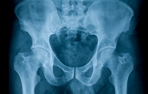 radiografía de cadera