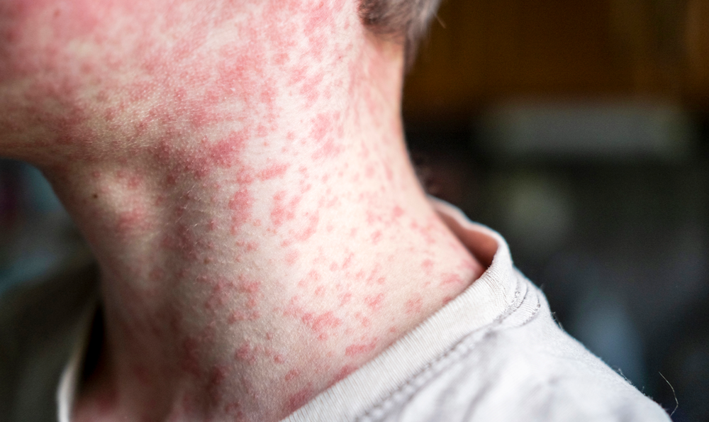 A boy with his neck covered in measles.