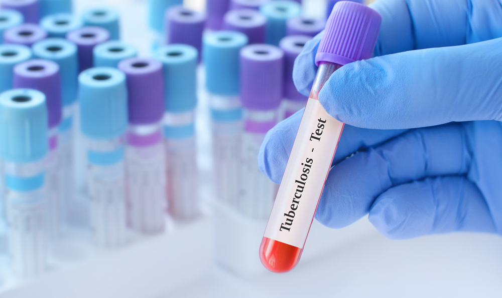 A tuberculosis blood test vial