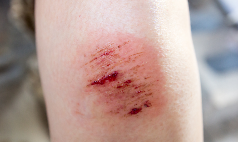 A wound on a knee