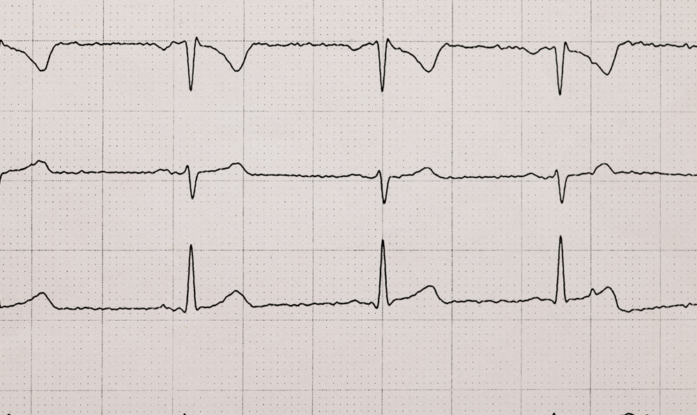 An image of a cardiac stress test result.