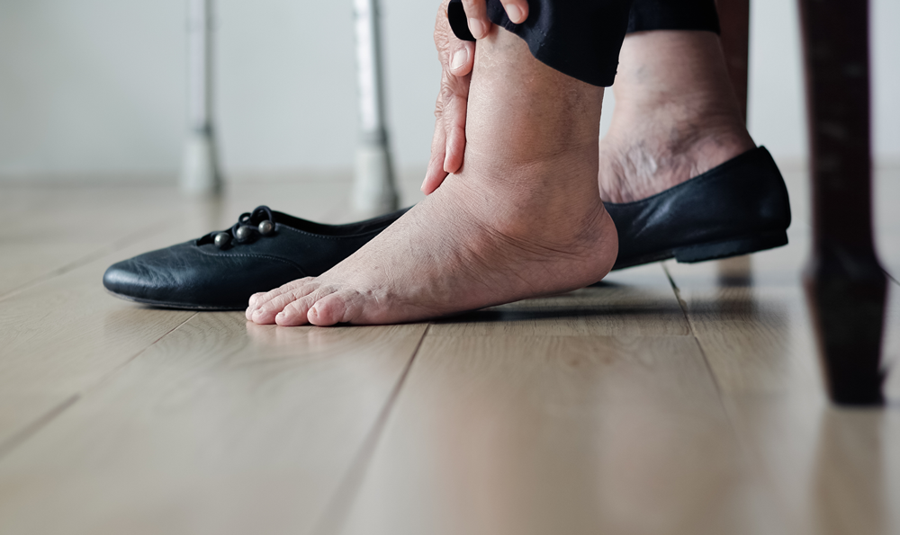 A picture of swollen ankles and feet due to venous insufficiency.