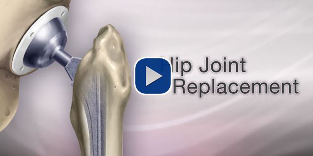 hip replacement video