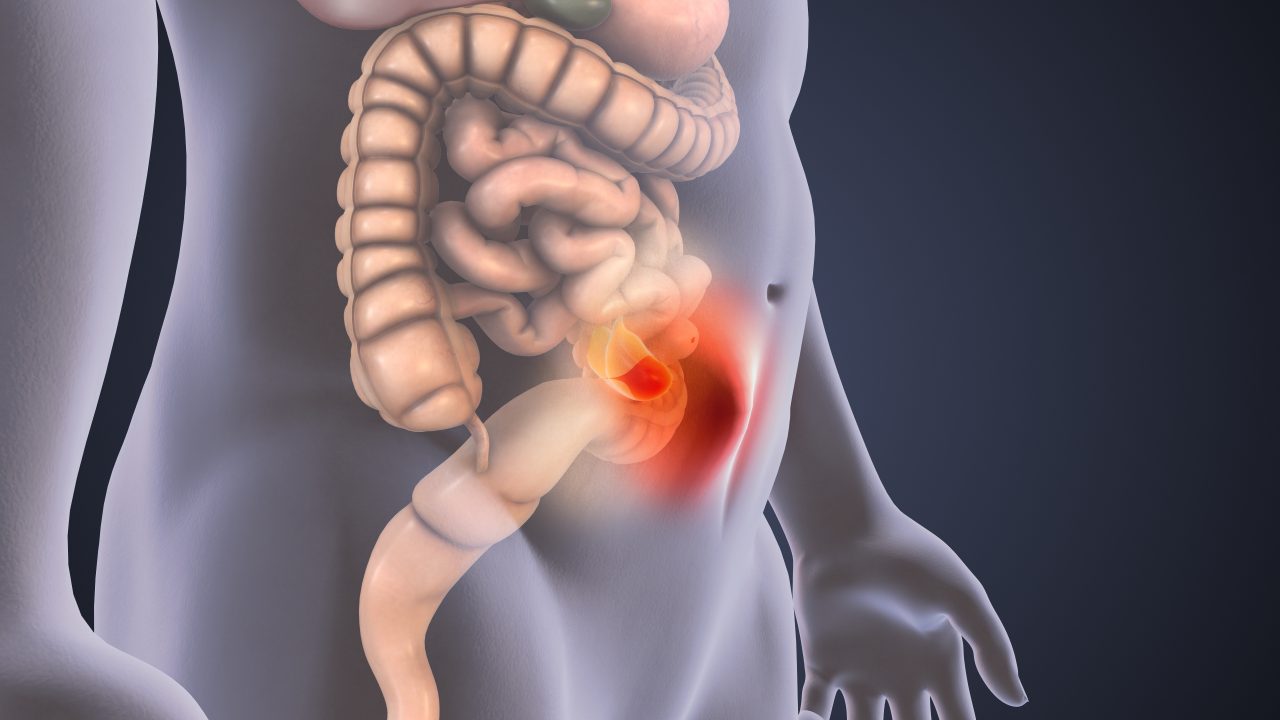 Abdominal hernia illustration.