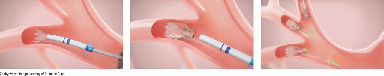 Lung Valve Demonstration