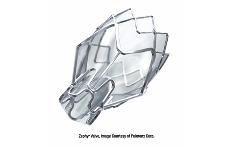 Zephyr Valve