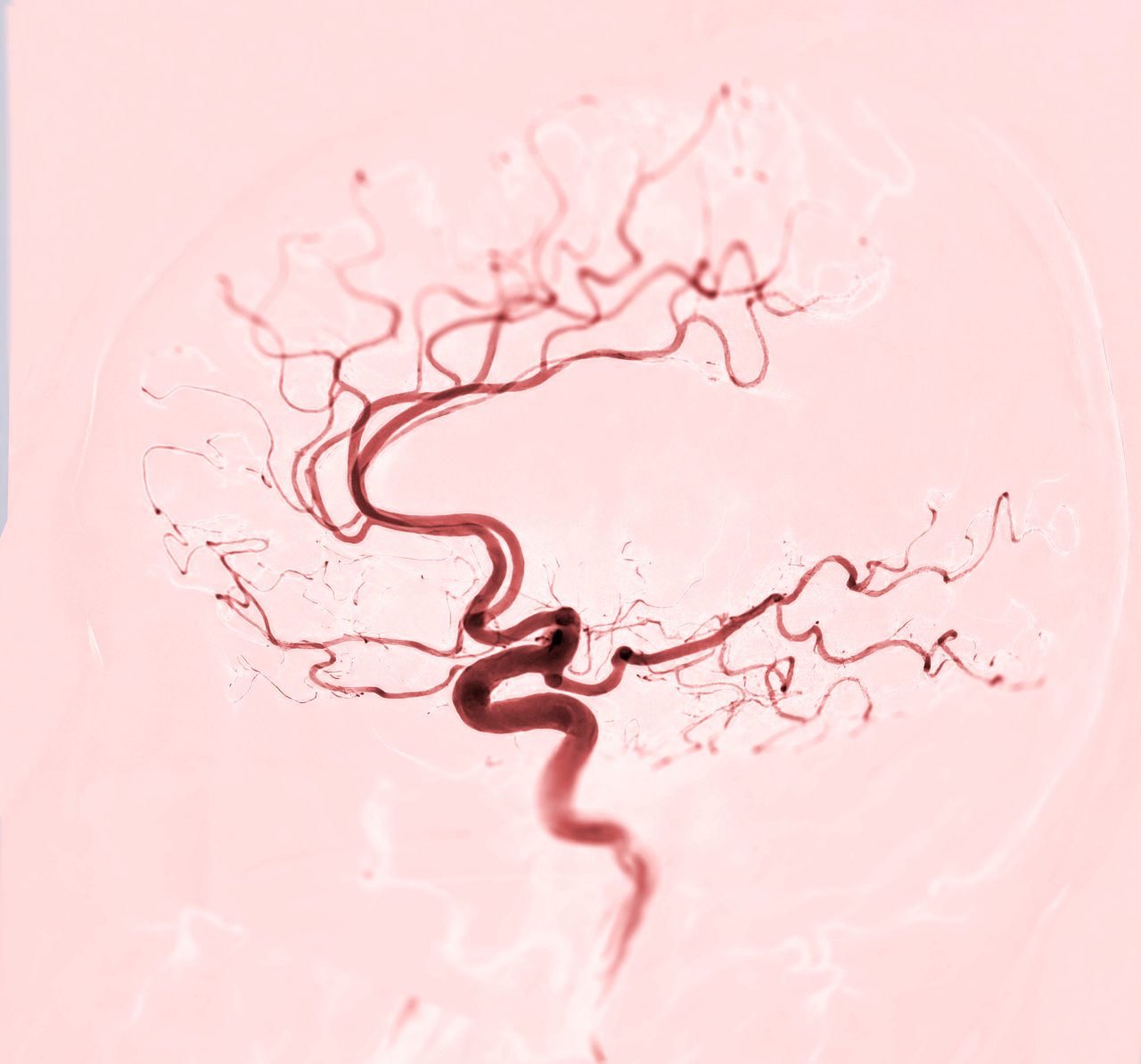Cerebral angiography Lateral view image from Fluoroscopy in intervention radiology showing cerebral artery. -